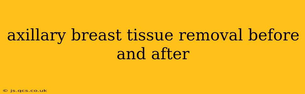 axillary breast tissue removal before and after