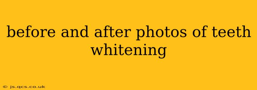 before and after photos of teeth whitening