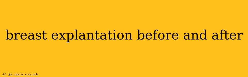 breast explantation before and after