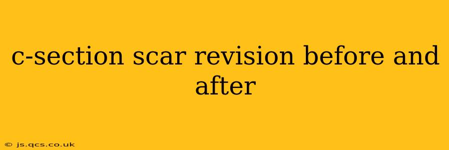 c-section scar revision before and after