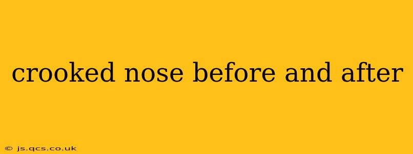 crooked nose before and after