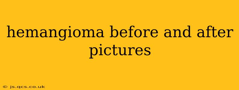 hemangioma before and after pictures