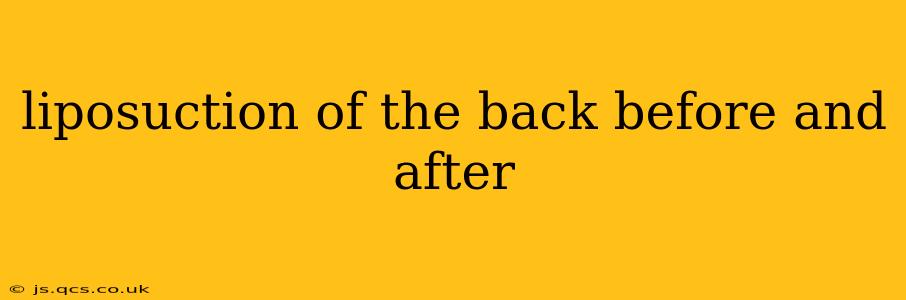liposuction of the back before and after