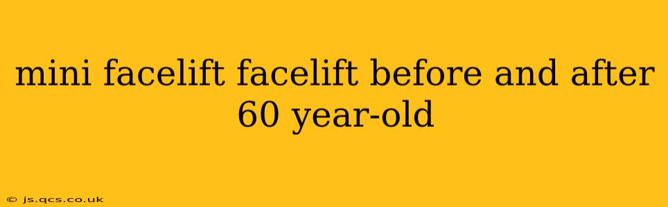 mini facelift facelift before and after 60 year-old