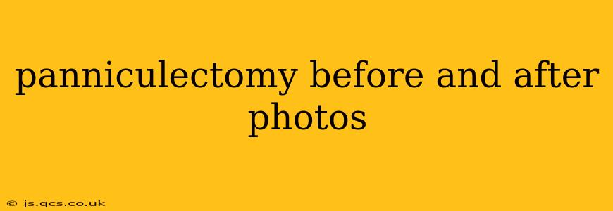 panniculectomy before and after photos