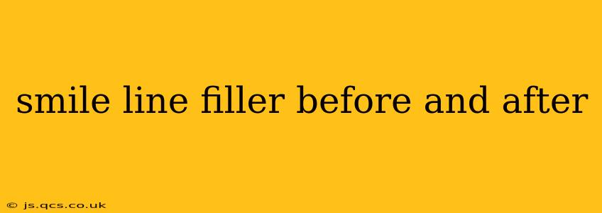 smile line filler before and after