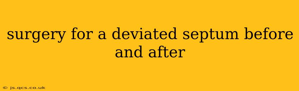 surgery for a deviated septum before and after