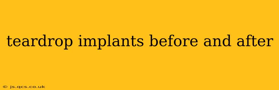 teardrop implants before and after